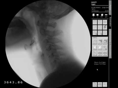 Swallow Study - Solid Texture/Cracker - Modified Barium Swallow Study (MBSS) Lateral View HD