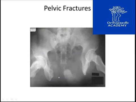 Pelvic Fractures
