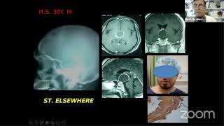 Dr. Ibrahim Sbeih - Radical Excision of craniopharyngioma