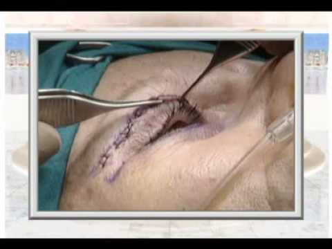 Eyelid surgery,Blepharoplasty,UK-Greece=Cyprus-Dr Kapositas,Global Plastic Surgery