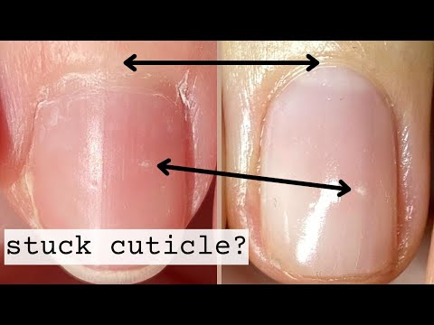 How to Correct Stuck Skin Around The Nails  [3 Week Progress]