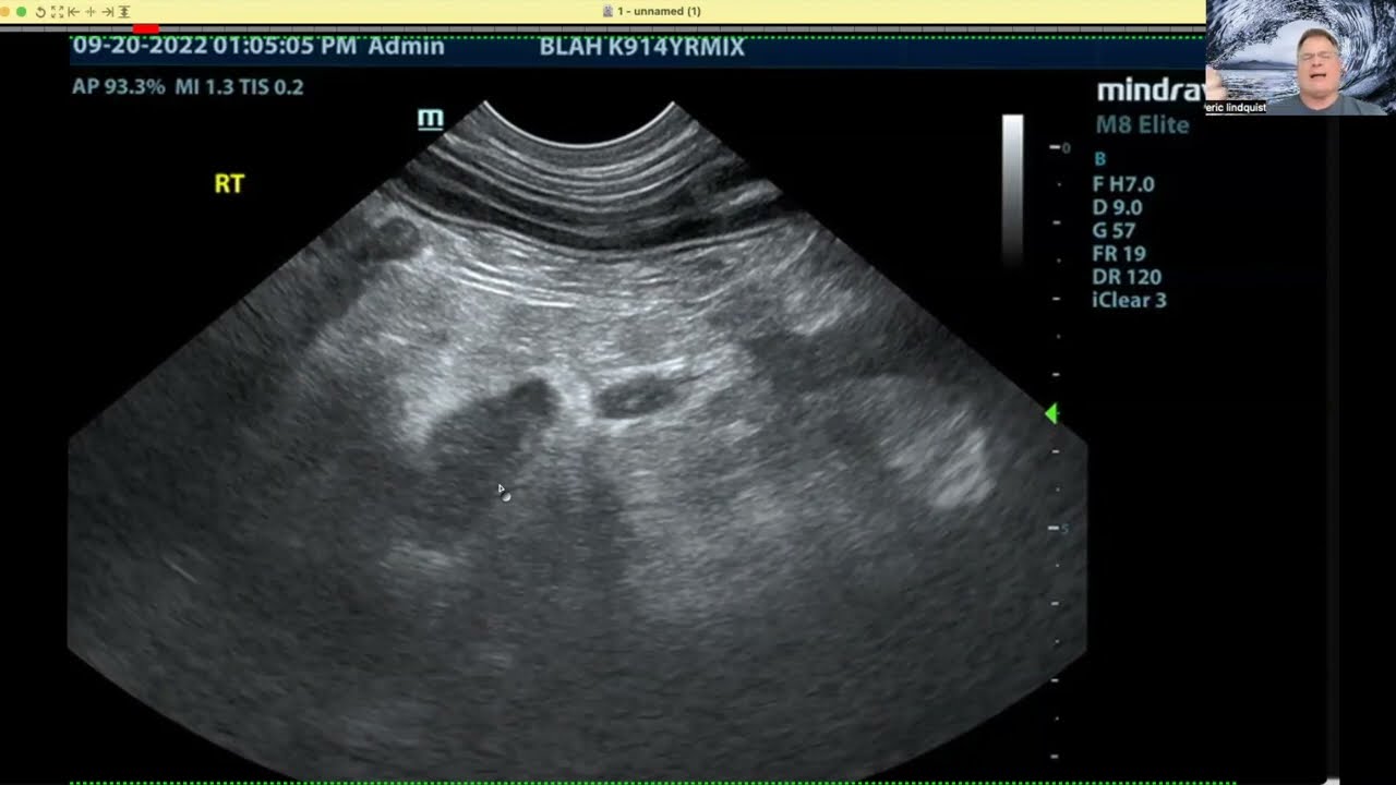 The Cost of Missing a Lesion [5 Sono-Minutes with SonoPath Ep.5]