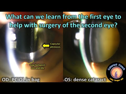 What can we learn from the first eye cataract surgery to help with the second eye?