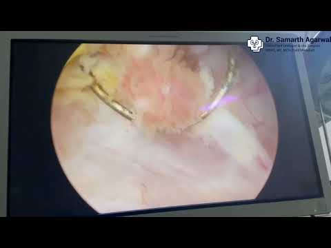 Transurethral Resection of Bladder Mass - Demonstration | Dr Samarth Agarwal