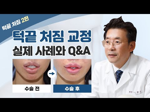 윤곽수술 후 앞턱 처침 등의 부작용과 개선할 수 있는 방법 2편✅