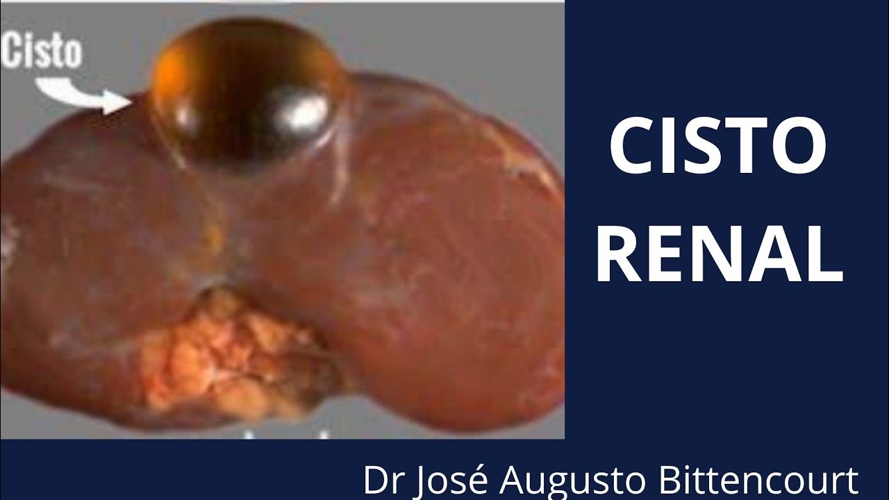 Cisto Renal pode virar câncer