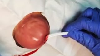 Sebaceous Cysts; What Are They World's Worst Cysts  (HD Popping)