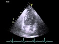 Patent formamen ovale (PFO) with severe right-left ...
