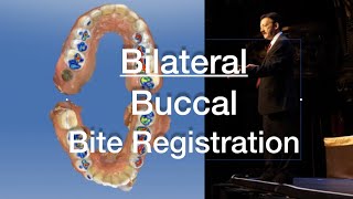 James Klim DDS - Bilateral Buccal Bite Registration For The Chairside CEREC Software