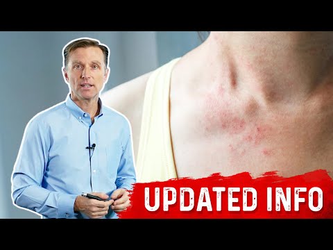 Keto Rash Is a Bile Deficiency – Bile Salts, Dietary Fats, and Keto Rash – Dr. Berg