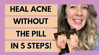 How to cure hormonal acne without birth control -5 STEPS!