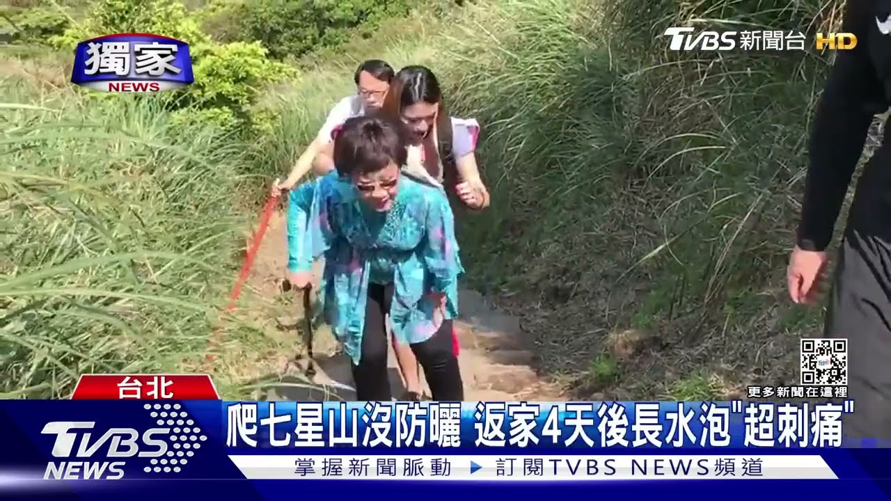 痛! 男爬山狂曬10小時手臂爬滿「密集水泡」