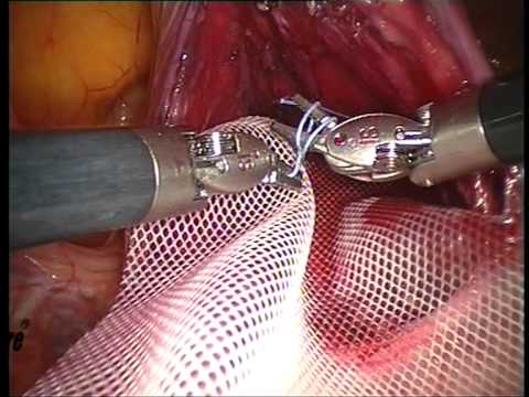 comment traiter prolapsus rectal