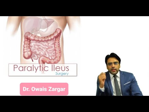 Topic | PARALYTIC ILEUS | Surgery Simplified by Dr.Owais Zargar |