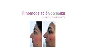 Rinomodelación - para una nariz bonita