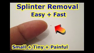 Small Tiny SPLINTER REMOVAL Trick - EASY LESS Painful STUBBORN Wood Thorn Metal Slivers