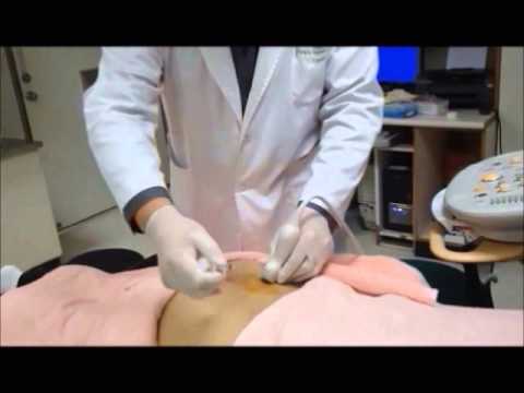 Ultrasound-Guided Sacroiliac Joint Injection Technique