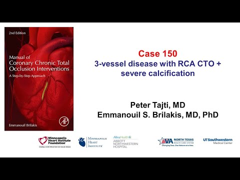 Case 150: Manual of CTO PCI - Three-vessel PCI with RCA CTO