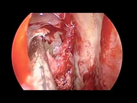 Ethmoid Mucopyocele - Middle Turbinate Concha Bullosa