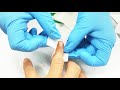 How to Apply Butterfly Stitches