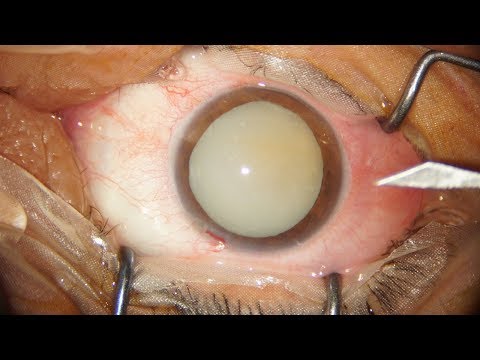 Mature Cataract: And How To 