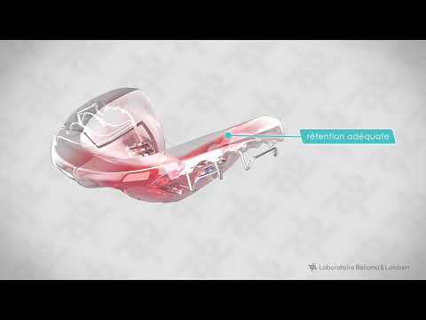Les composantes de l’appareil Sagittal modifié supérieur