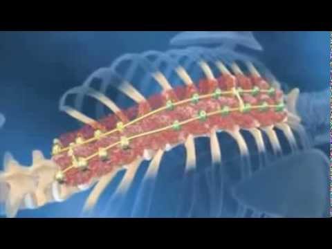 Корсеты сколиоза 3 степени Какой вид спорта может выпрямить осанку
