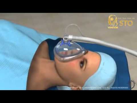 1 Blepharoplasty animation video new