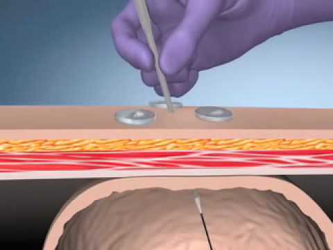 Kimberly-Clark MIC-KEY* J/TJ Introducer Kits - Endoscopic Placement