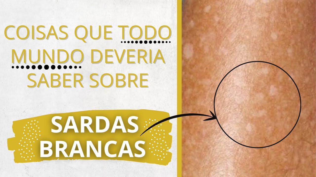 Coisas que todo mundo deveria saber sobre sardas brancas