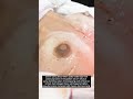 Menambah Volume Dan Kekencangan Payudara Dengan Breast Enhancement NOVI S CLinic