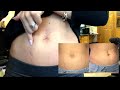 Stretch Mark UPDATE MicroNeedling