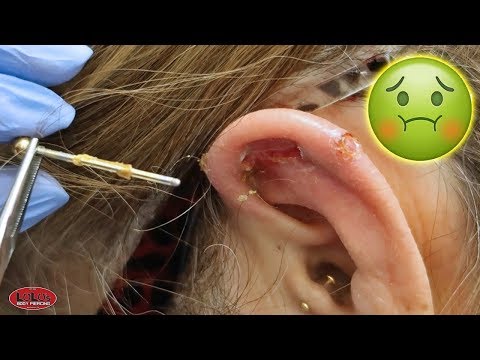 IS HER EAR PIERCING INFECTED!? Video