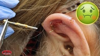 IS HER EAR PIERCING INFECTED!?