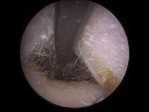 20 CLIENTS' EAR WAX REMOVAL PROCEDURES - #477