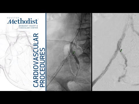 Internal Iliac Bifurcation VBX for Buttock Claudication (Alan Lumsden, MD, Ponraj Chinnadurai, MBBS)