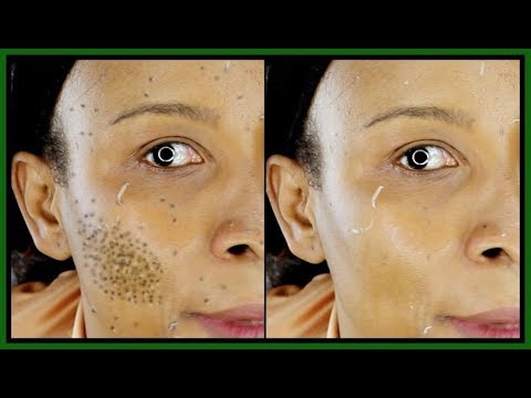 GET RID OF DARK SPOTS AND PATCHES  WHILE  LIGHTENING AND BRIGHTENING THE SKIN |Khichi Beauty