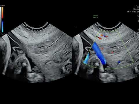 Challenging common misconceptions in vasa previa screening and diagnosis