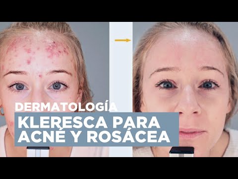 Mejora tu ACNÉ y ROSÁCEA con Kleresca