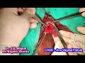 Ano Vaginal Fistula