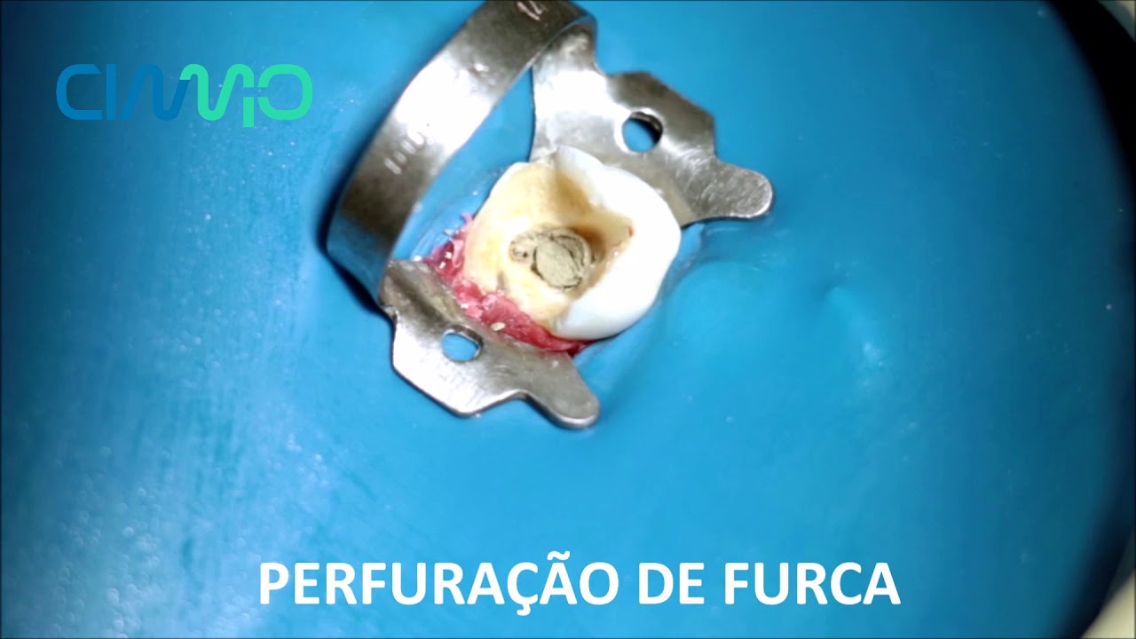 PERFURAÇÃO DE FURCA PBS CIMMO HD