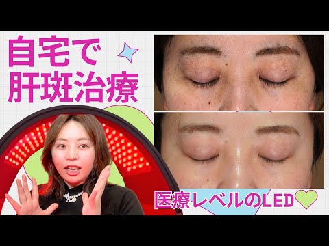 自宅で肌治療！？ 肝斑とシミが消えたLEDライト美容ダーマラックスって？