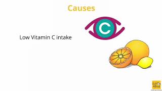 Eye Cataract