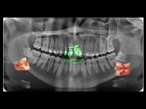 Extracción de cordales en Maxilofacial Fragozo Barranquilla