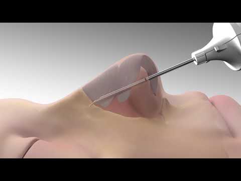 Graphic of a device being inserted into a patient's nose