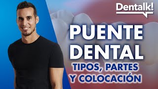 Todo sobre el PUENTE DENTAL - ¿Son una buena opción? ¿Qué tipos hay? ¿Cómo se colocan? | Dentalk! © - Clínica Dental Pardiñas