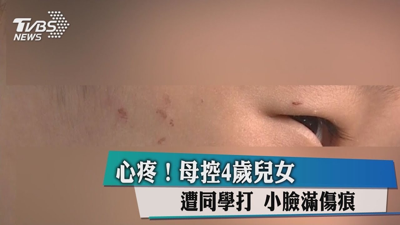 心疼!母控4歲兒女遭同學打 小臉滿傷痕