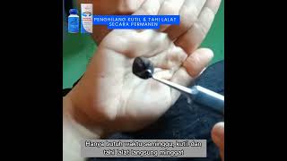 Download lagu Swiss Paris Lotion - Solusi Ampuh Menghilangkan Kutil dan Tahi Lalat mp3 Download lagu Swiss Paris Lotion - Solusi Ampuh Menghilangkan Kutil dan Tahi Lalat mp3