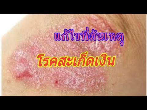 ครีมโรคสะเก็ดเงิน psora ไม่ว่าจะเป็นโรคสะเก็ดเงินส่งผ่าน