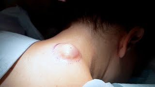 Cyst removal.